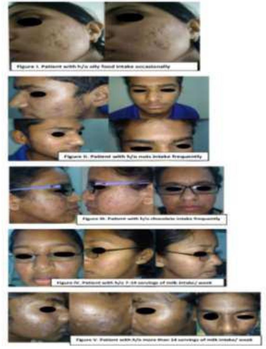Kitavan Teeth (PDF) Correlation of acne with dairy products -Fact or a Misconception