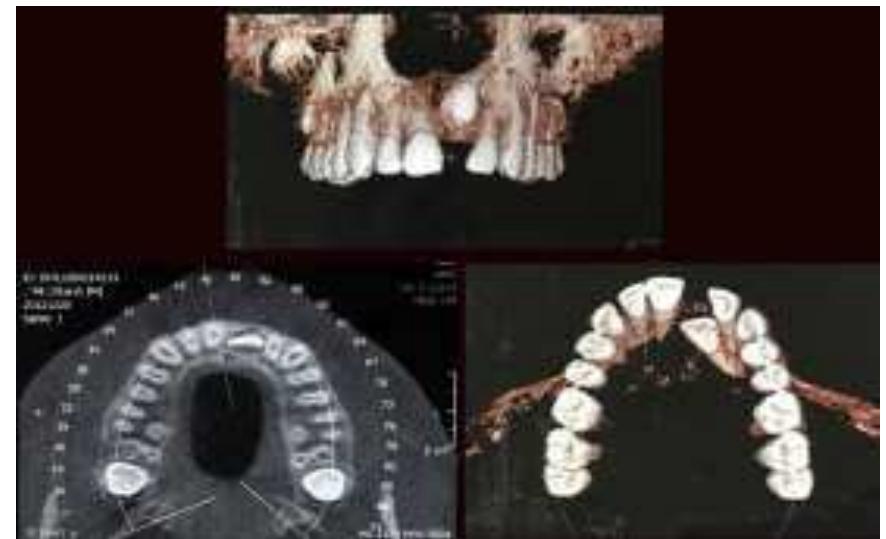 (PDF) Orthodontic management of impacted teeth: An overview