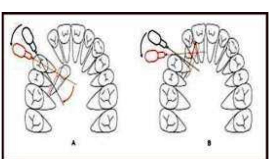 (PDF) Orthodontic management of impacted teeth: An overview