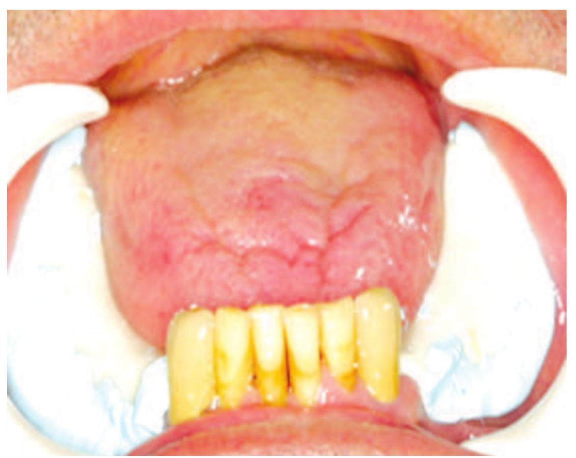 Impression of the edentulous ridges without any compression.