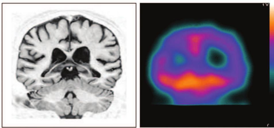 Dementia with lewy bodies. sagittal spect showing posterior