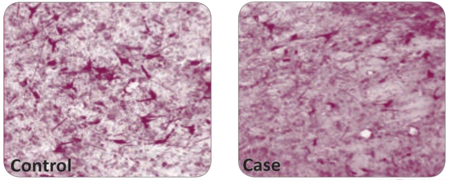 Labeled cells in ipsilateral centromedial nuclei in control
