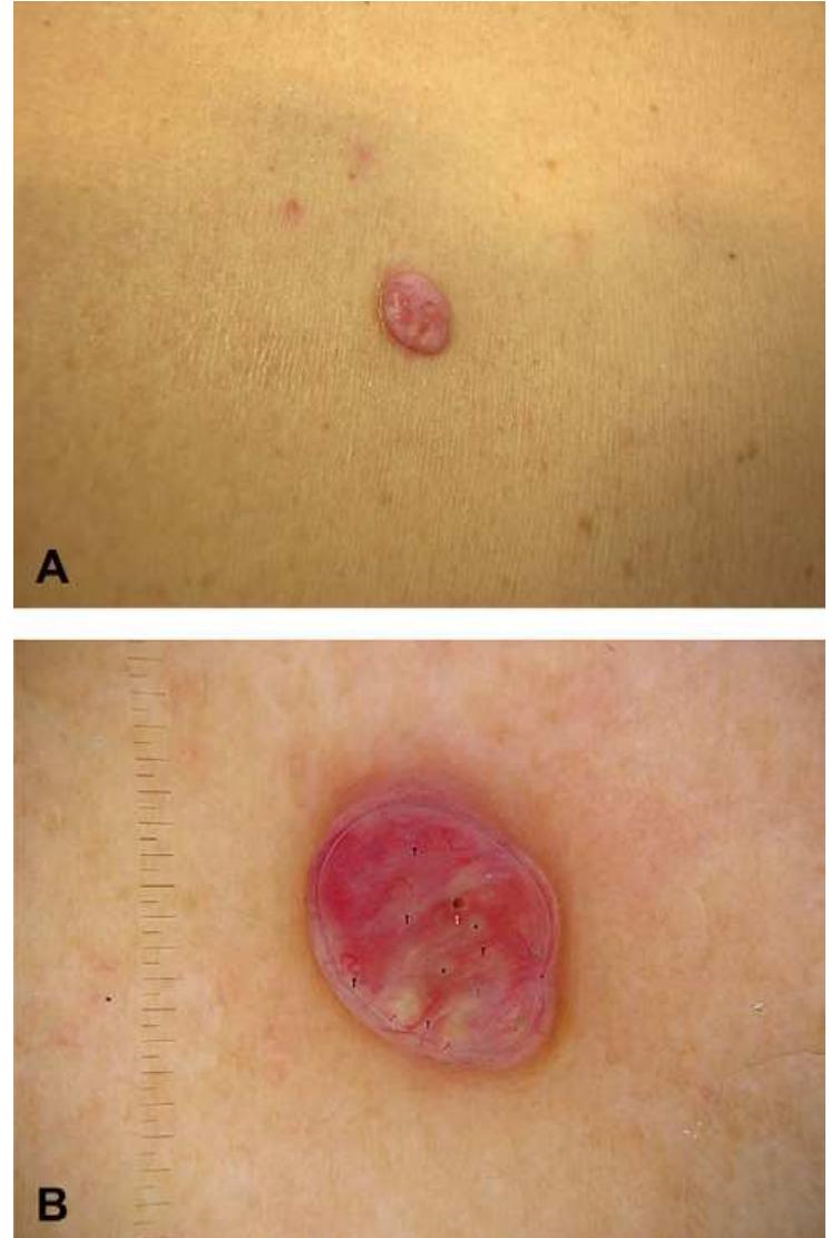 (PDF) Pitfalls in the dermoscopic diagnosis of amelanotic melanoma