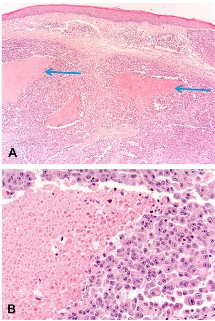 (PDF) Pitfalls in the dermoscopic diagnosis of amelanotic melanoma