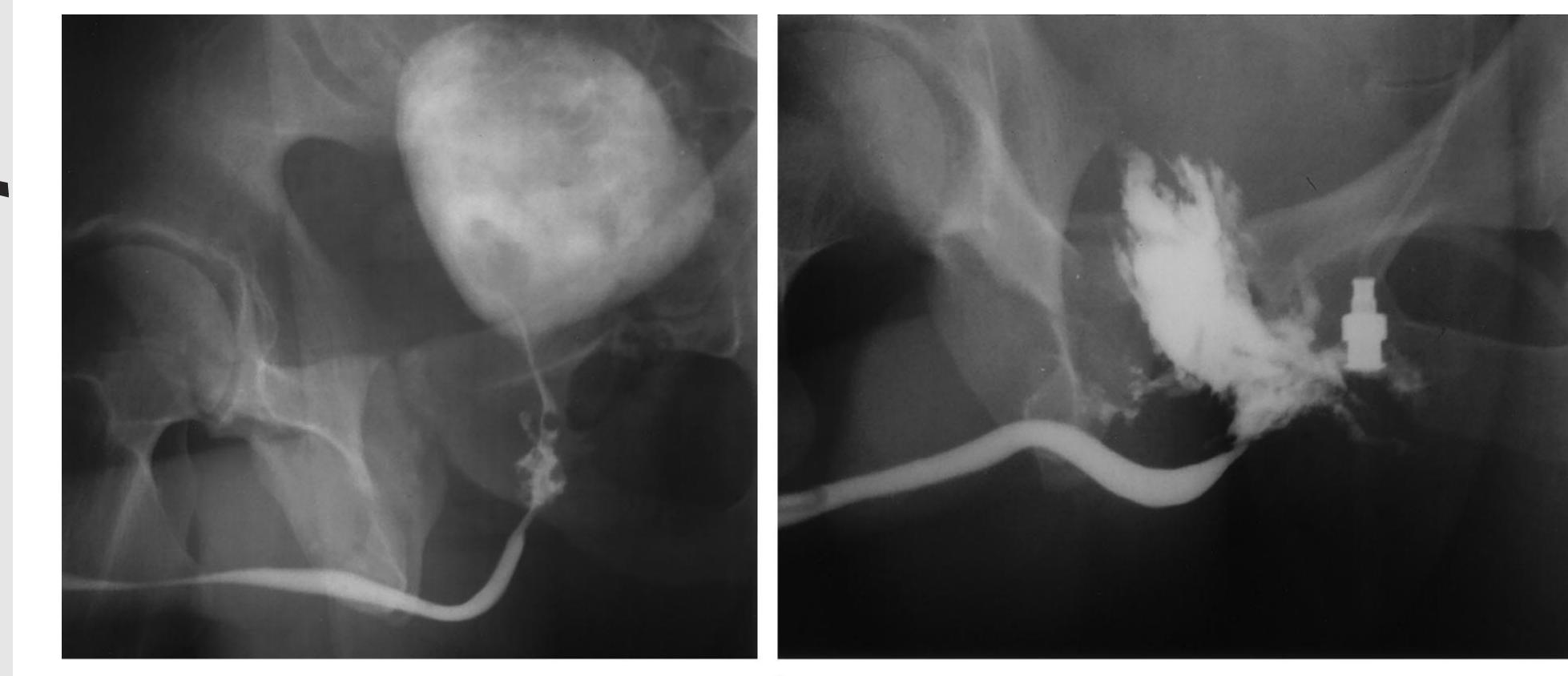 Figure 11 - Imaging of Urethral Disease: A Pictorial Review1