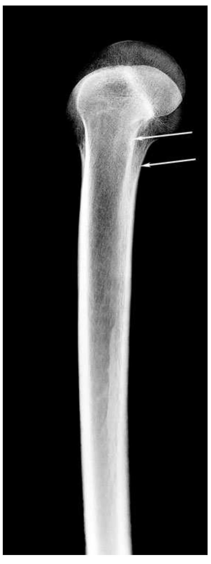 Intercondyler Ridge Figure 2 - from Measuring the Intercondylar Shelf Angle