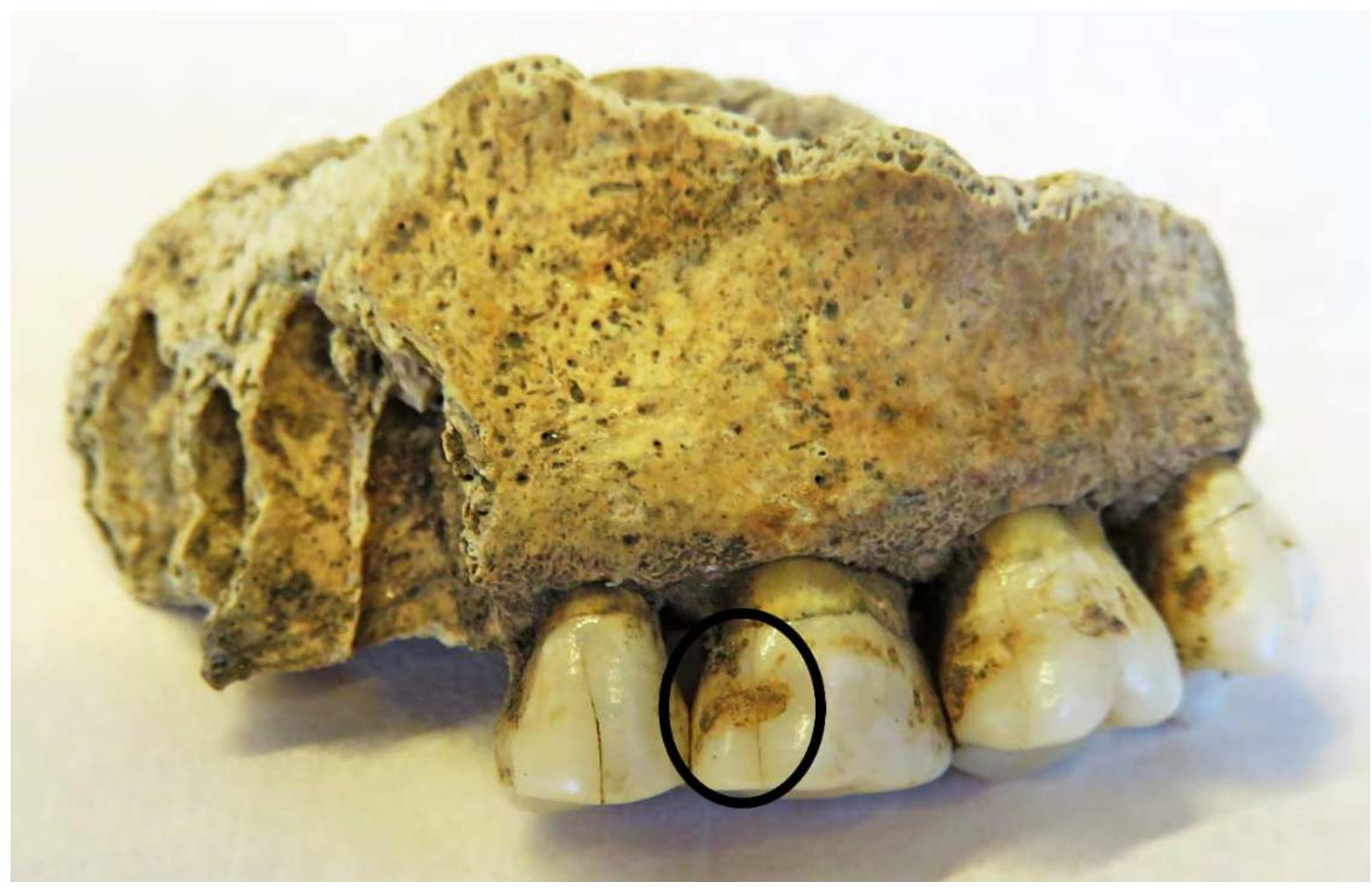 Figure 2. The indicated sampled area of the calculus on the tooth of the individual from the Mesolithic grave 18(3) at the site of Hajducka Vodenica. 