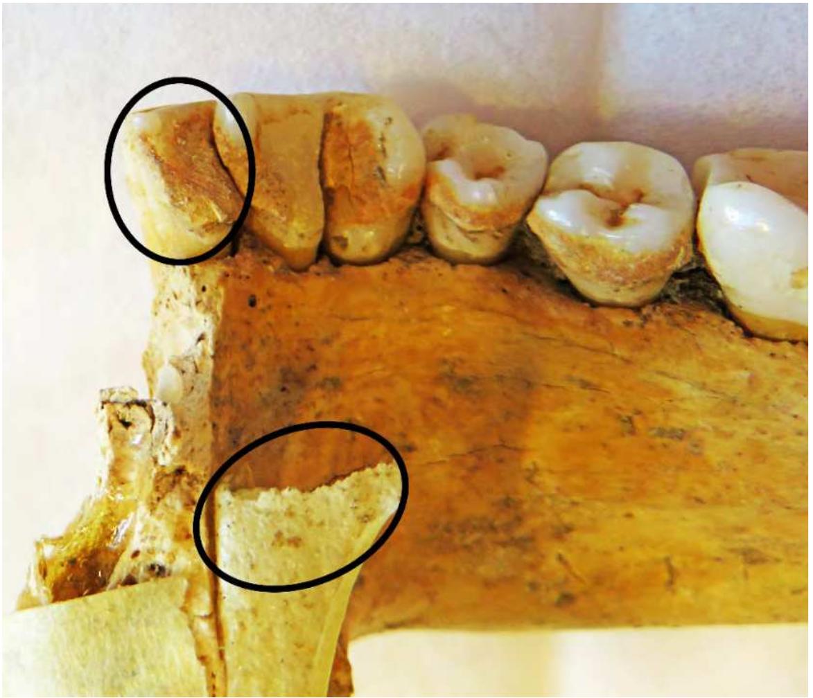 Figure 3. The marked sampled area of the calculus on the tooth of the individual from the Mesolithic/Neolithic grave 1 at the site of Lepenski Vir. The control-sampled piece of masking tape also indicated. 