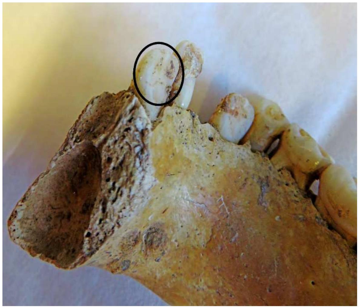 Figure 4. The surface of a tooth after the removal of the calculus of the individual from the Mesolithic/Neolithic grave 61 at the site of Lepenski Vir. 