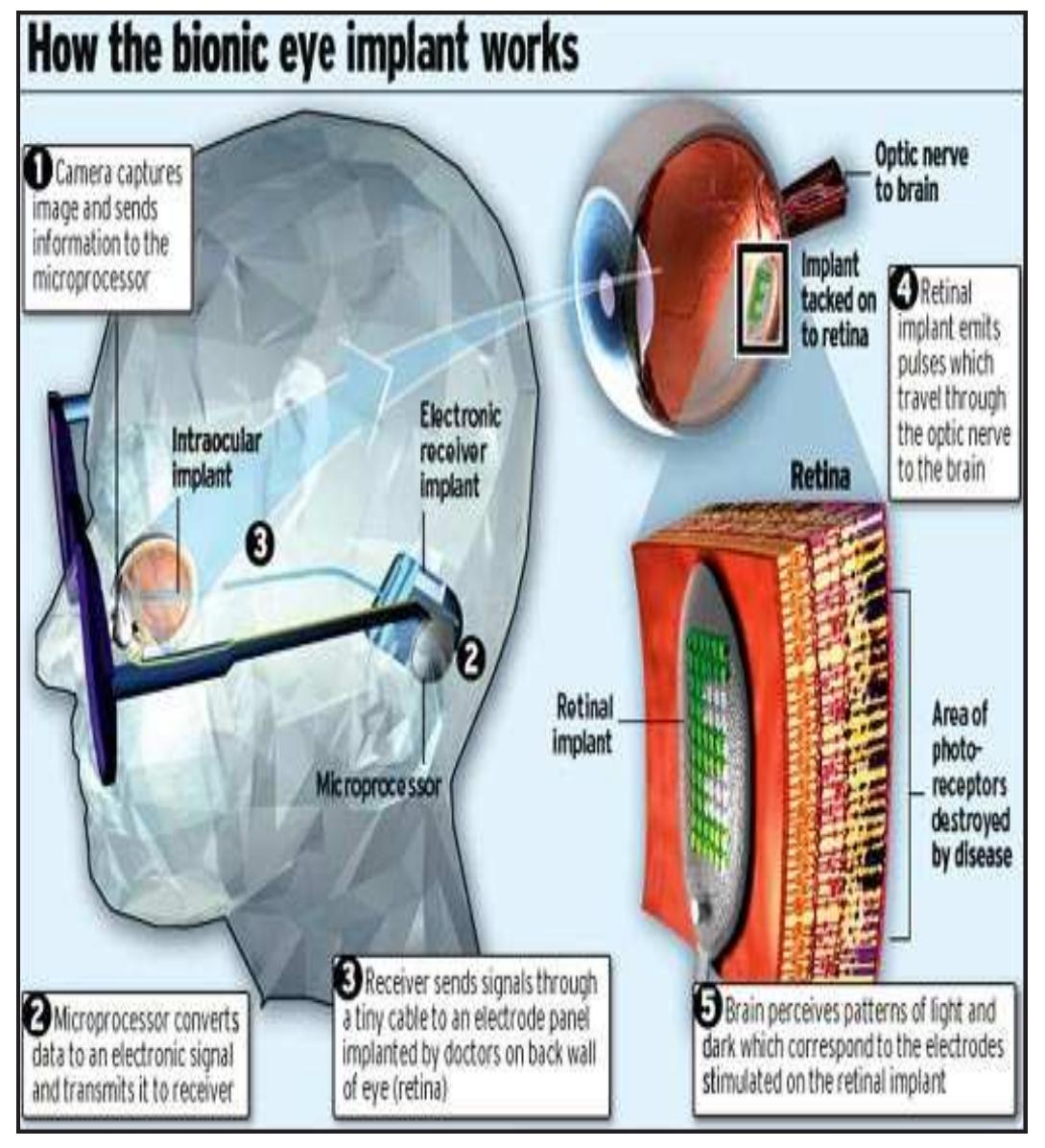 (PDF) Bionic Eye