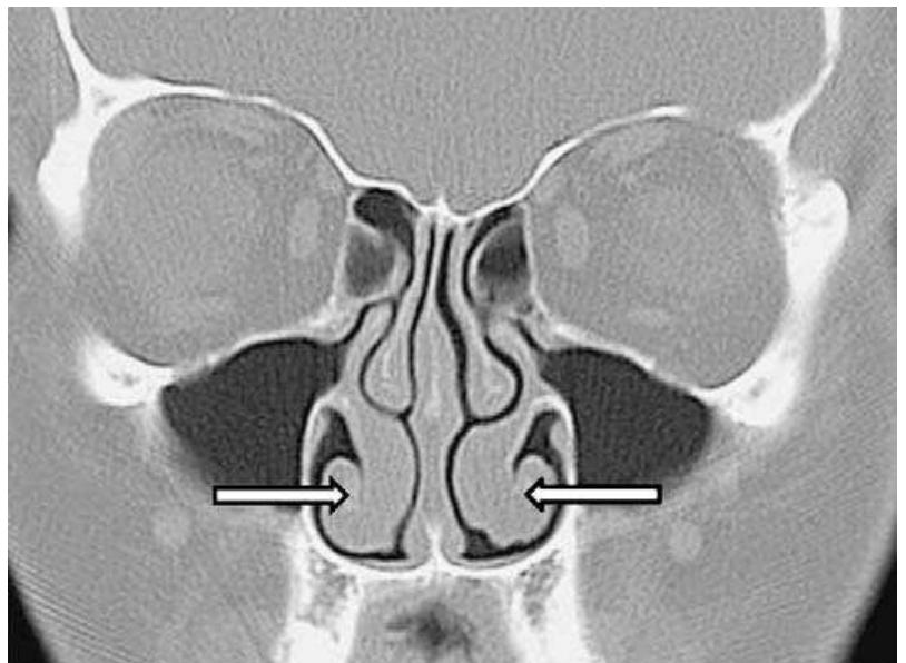 Bilateral Rhinitis Coronal ct demonstrating bilateral hypertrophy of the soft
