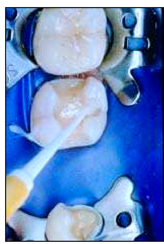 Fpd Sign Figure 2 - from Tooth Structure Removal Associated with