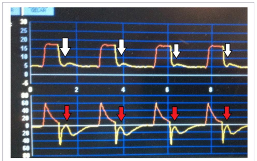 (PDF) Identifying Patient-Ventilator Asynchrony Using Waveform Analysis