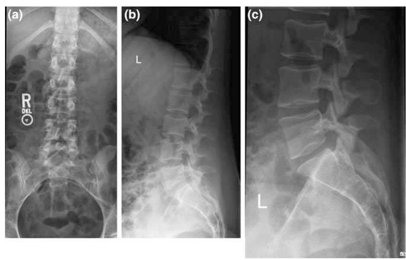 Lumbar Rework Stay Loop Figure 32 - from Spinal Imaging and Image Analysis