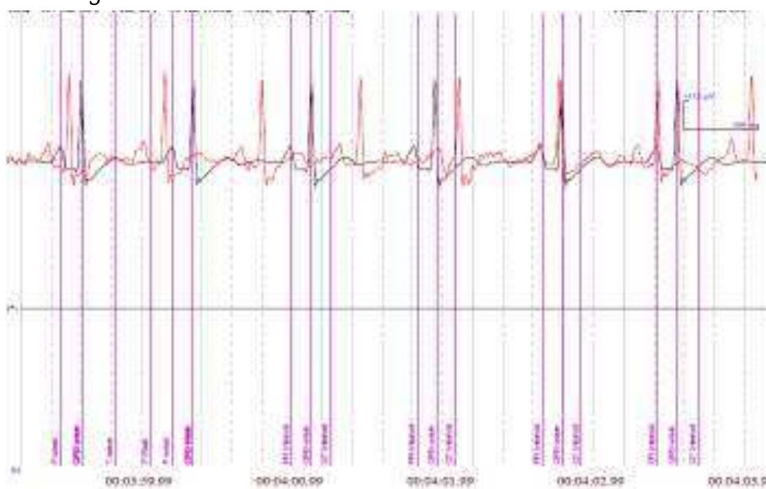 (PDF) A Review of ECG signals for Human Emotion Detection