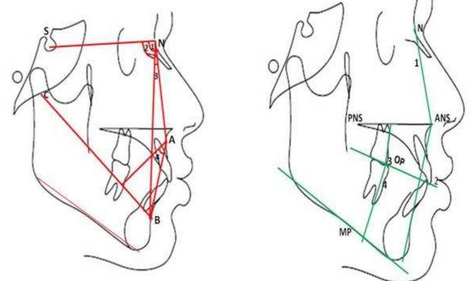 The cephalometric laniimarks and horizontal measurements