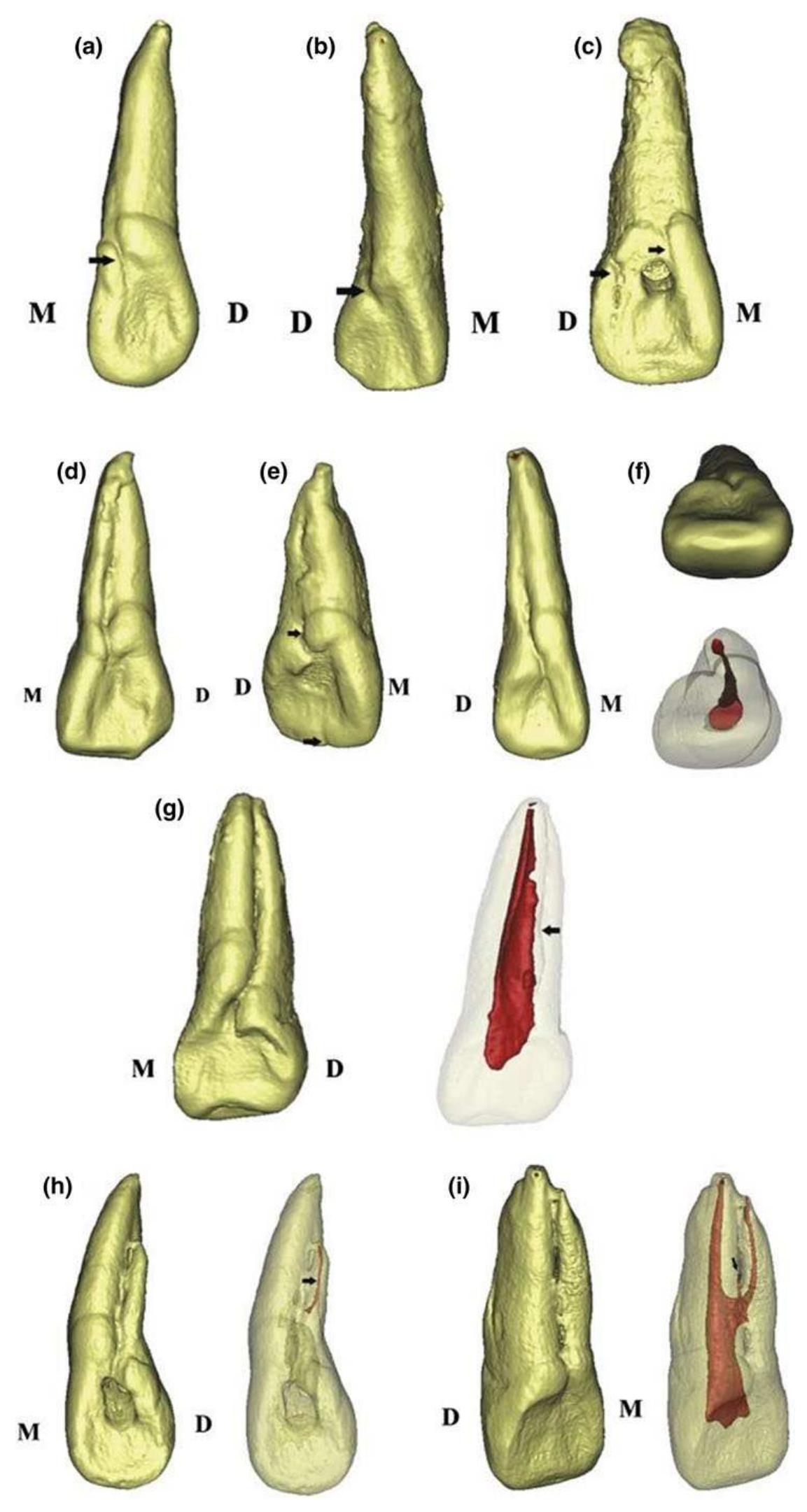 Figure 6 - from A new system for classifying tooth, root and