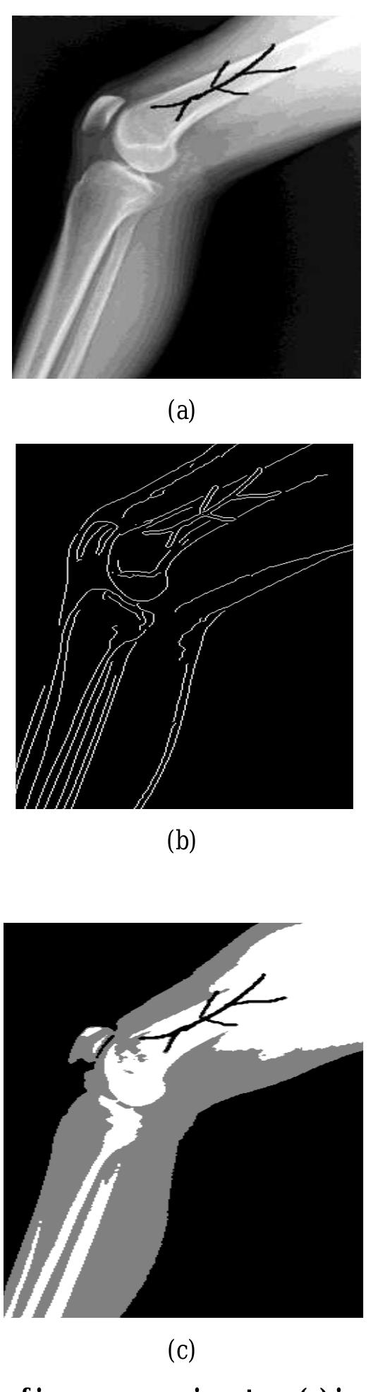 (PDF) Detection of Bone Fracture using Image Processing Methods