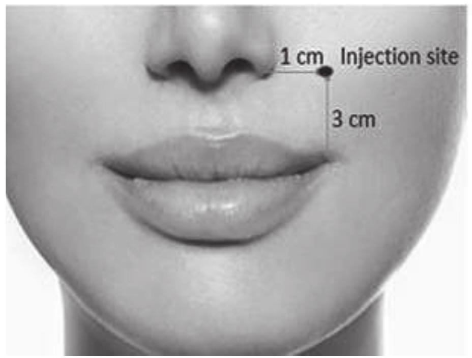 Risorius Botox Injection (PDF) Botox – the magical spell of dentistry: A literature review