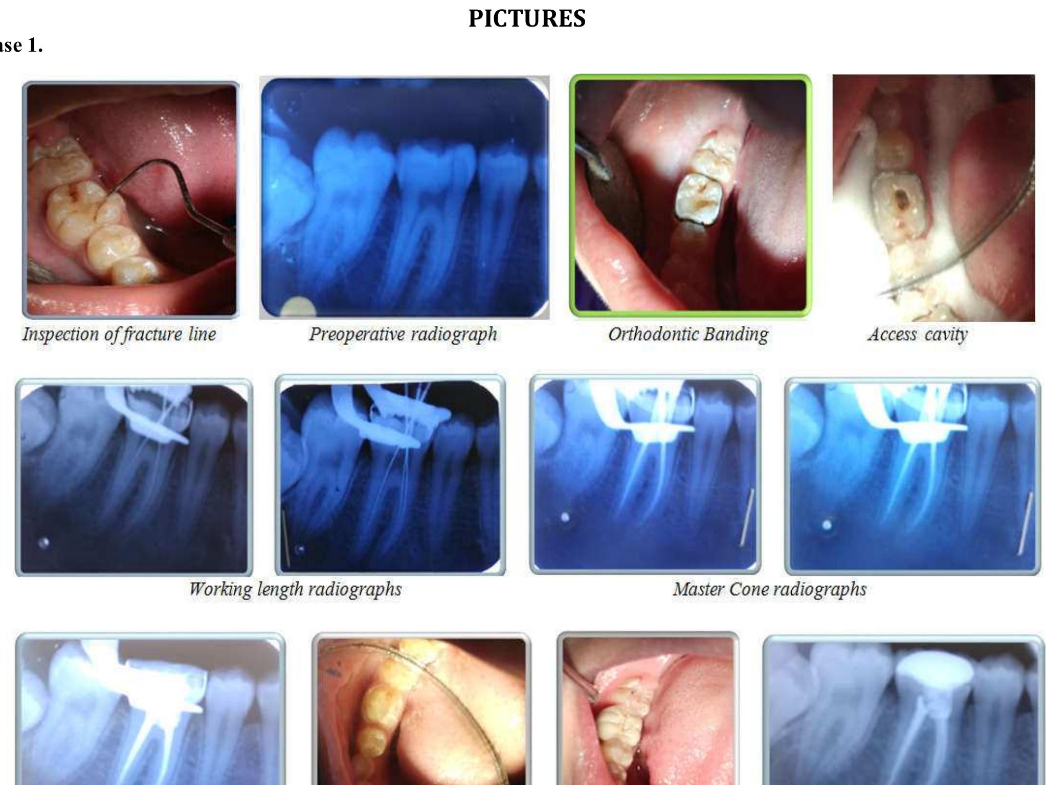 Post obturation radiograph pfm crown cementation and