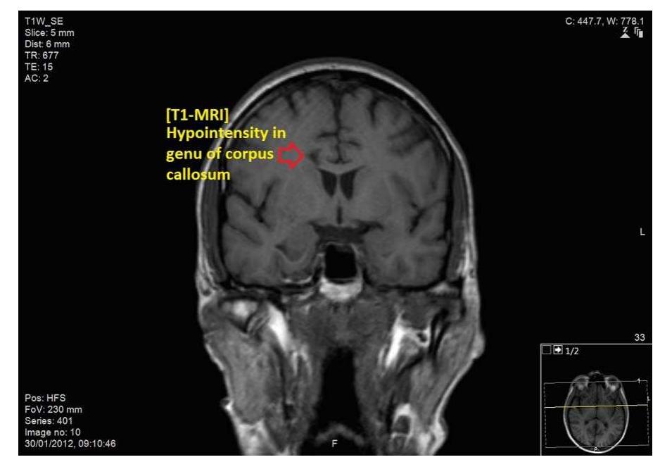Splenium Mri Con Ronal Figure 2 - from Partial interhemispheric disconnection