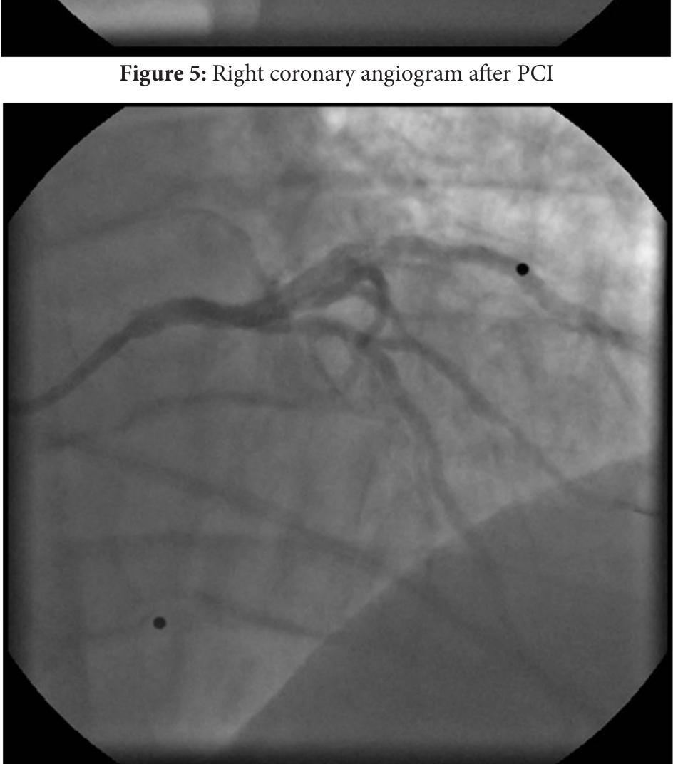 Right coronary angiogram after pci figure 6: left coronary