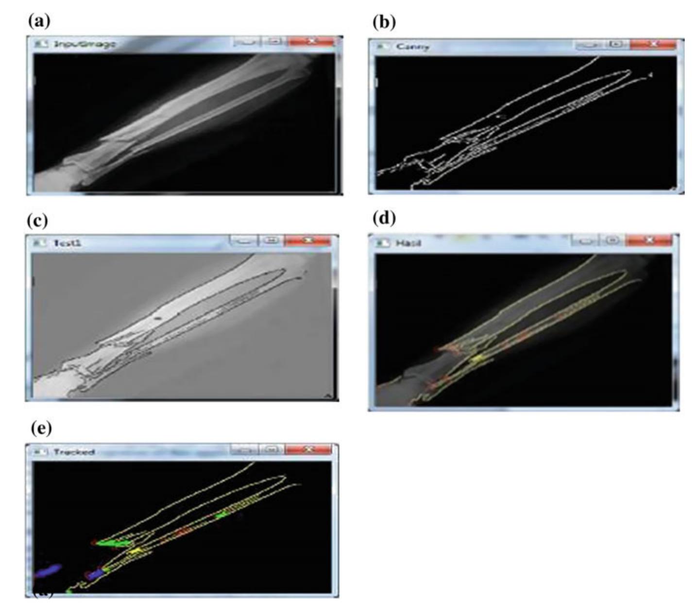 (PDF) Bone Fracture Detection Using Edge Detection Technique