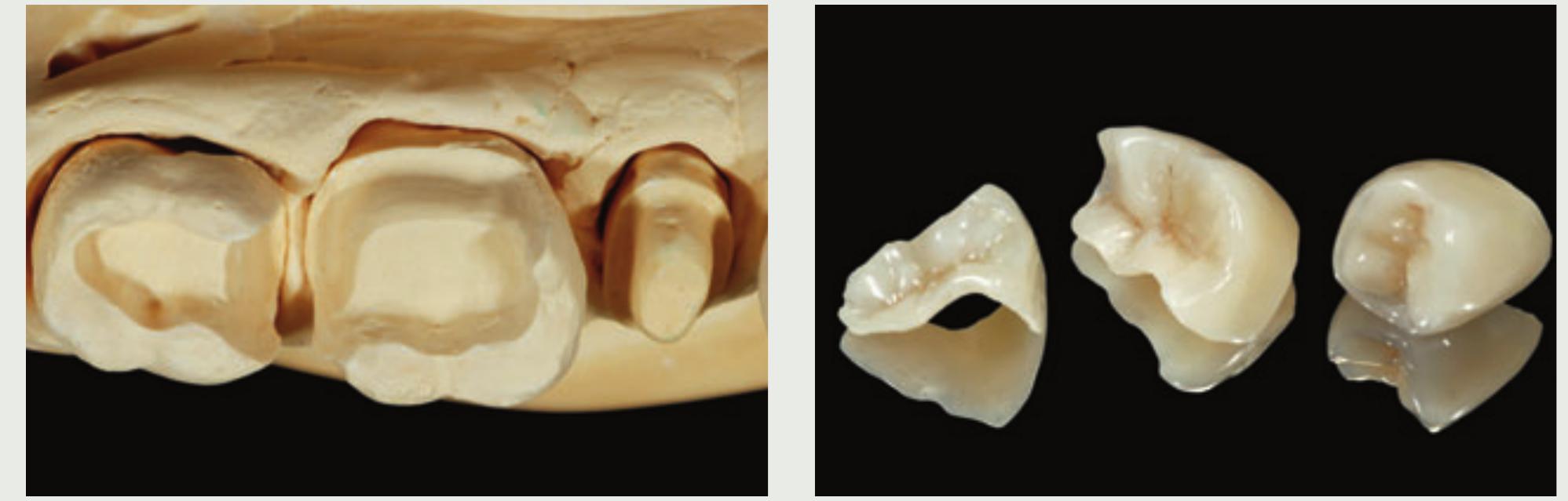 (PDF) CASE REPORT Reconstruction of Endodontically Treated Posterior ...