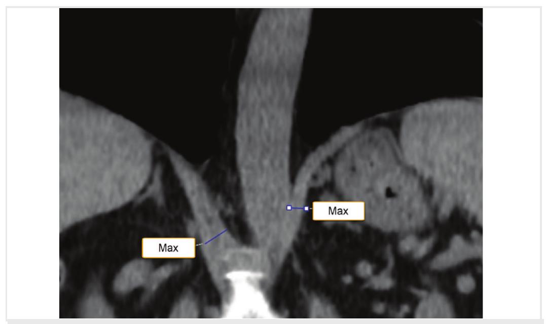 C) coronal reformatted computed tomography images at the