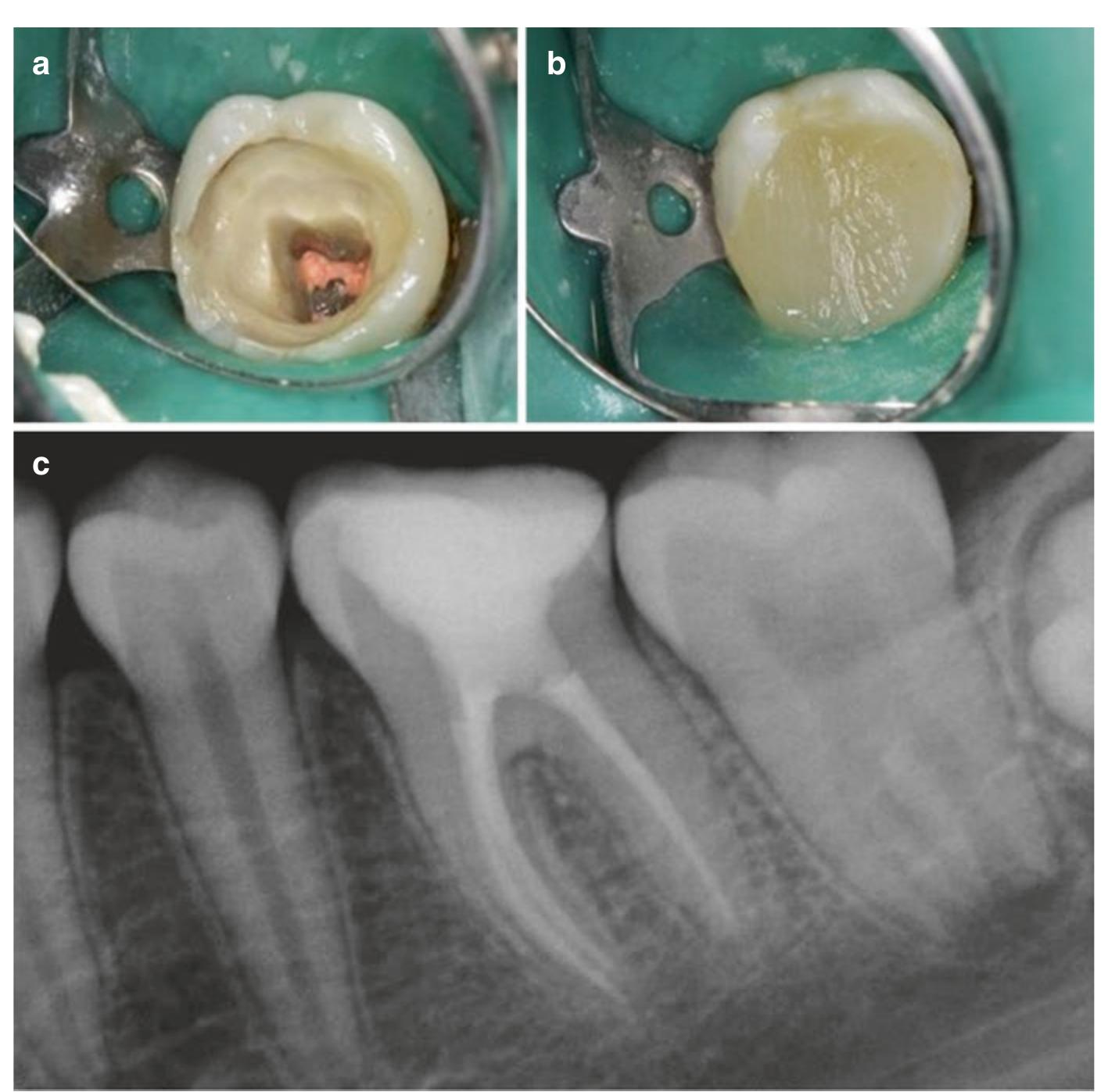 Compromised Tooth 14 (a) clinical image of a structurally compromised