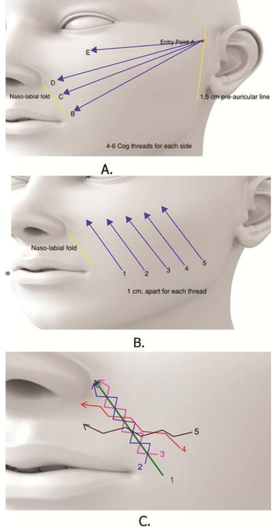 健康・医学 Thread Lifting Techniques PDF] Thread Lift: Classification, Technique, and How to