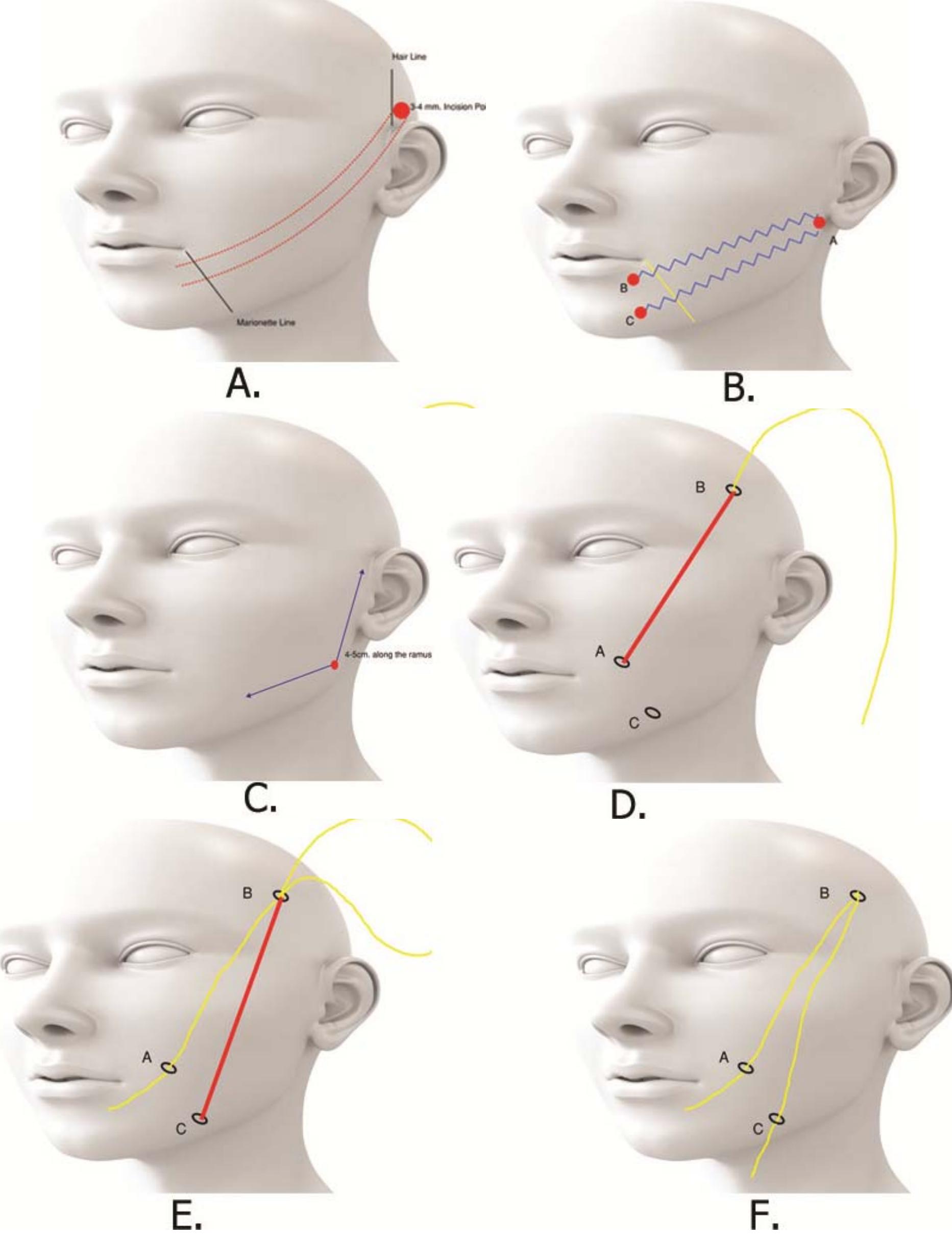 Bi Directional Thread (PDF) Thread Lift Classification Technique and How to Approach to the ...