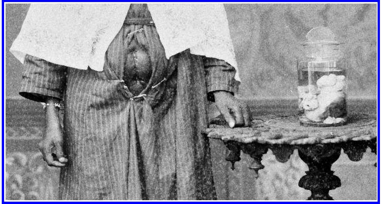 SS eee aS TIE  The caption under the first portrait reads, “40 year old negroid [zenciye] resident of Kasimpasa, Tenstif Kadin’s ‘picture of health’ following a median laparotomy resulting in the complete removal of the tumor and uterus.” Indeed, Tenstif Kadin is wearing a hospital-issued gown care- fully pinned open to reveal the laparotomy scar on her abdomen. And on the decorative table beside her, in lieu of the typical stack of books or vase of spring blossoms, is a specimen jar containing the tumor that was removed from her, thus displaying to her, the photographer, possibly to 