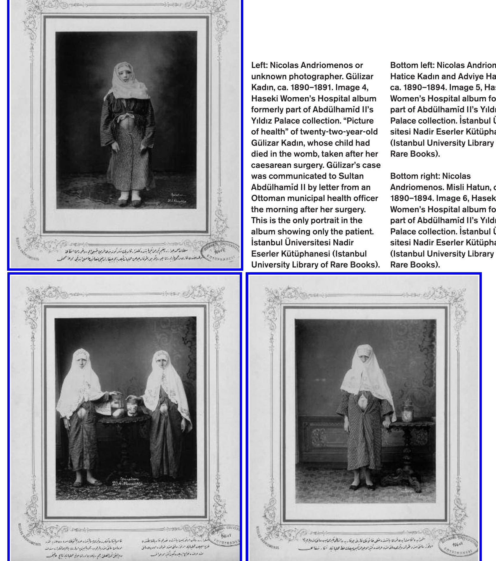 type. The first jar, we are told, contains one stone the size of a walnut, the other the size of a hazelnut. The rest are tumors. All were removed vaginally. That the women from whom these were removed are not pho- ographed alongside them suggests that the visibility of the surgical scar is central to the earlier portraits.9 Indeed the bared scar itself is the most direct site rendering healing visible. That is, we have no reason to doubt hat these patients, too, regained their health, but their scars would not have been photographable in the same manner. The last page includes he doctor’s name and title—gynecologist and obstetrician of Haseki Women’s Hospital and the obligatory term servant (kullar1), indicating an address directly to the sovereign. Captivated by the images, I set out to understand how and why such an album might have been produced.  