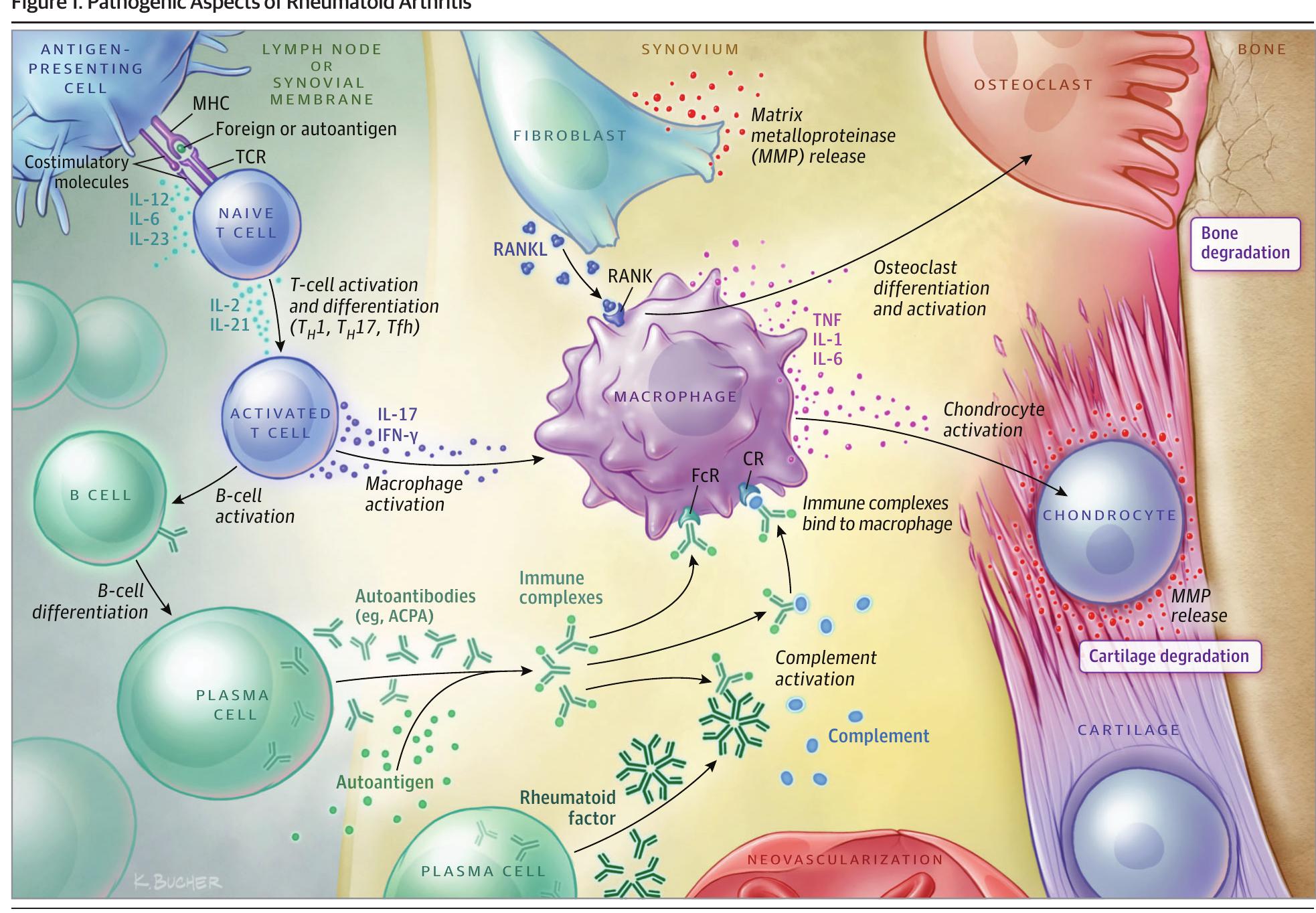 (PDF) Diagnosis and Management of Rheumatoid Arthritis A Review
