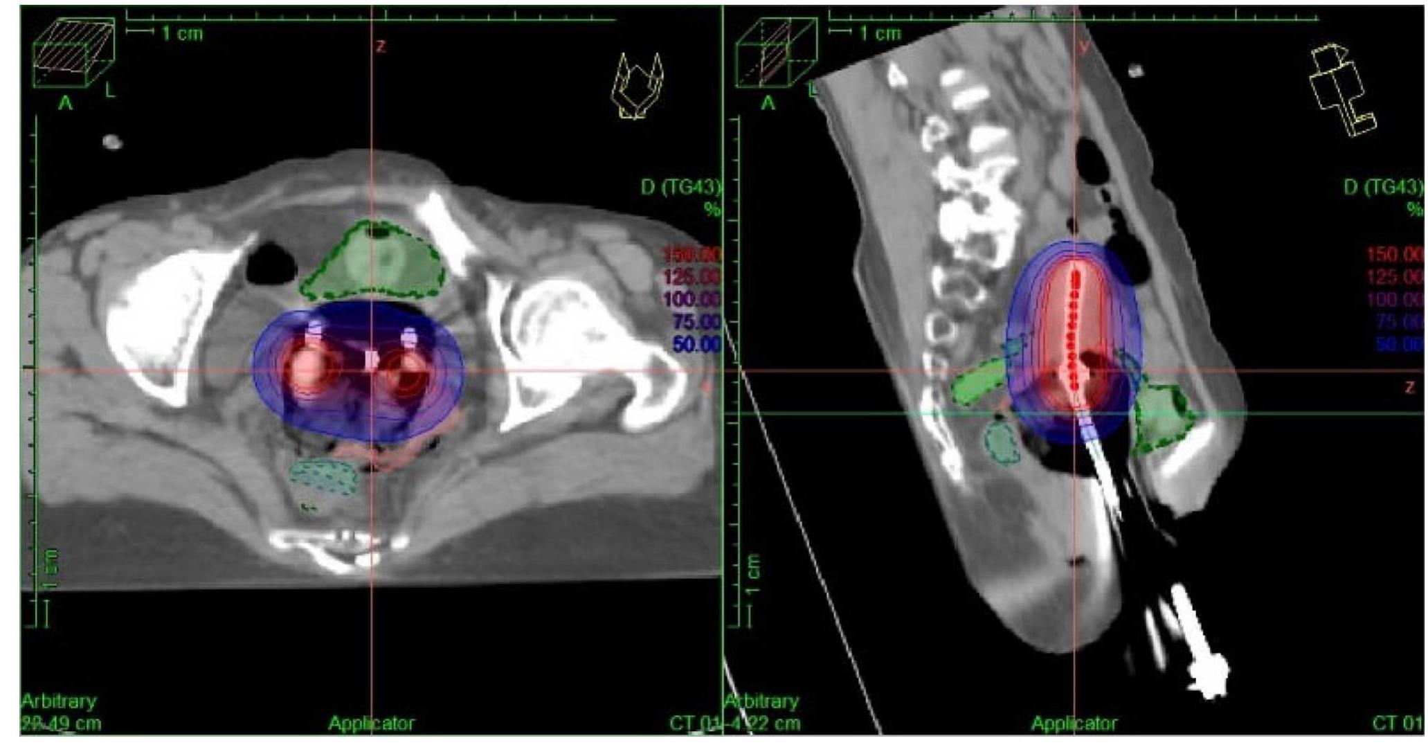 (PDF) Analysis of Volumetric Dosimetry of Target Volumes and Organs at ...