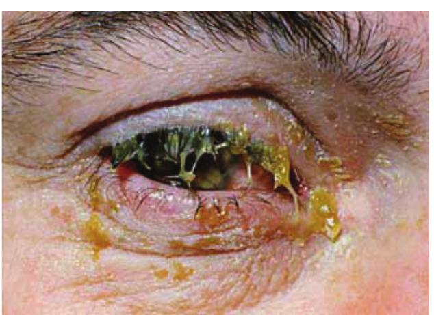 bacteria is indisputable from a modern perspective, but in this case, the patient would be treated only after 17 days of the remedy’s manufacture. Actually, the remedy should have been put to use immediately after an infection had become apparent. 