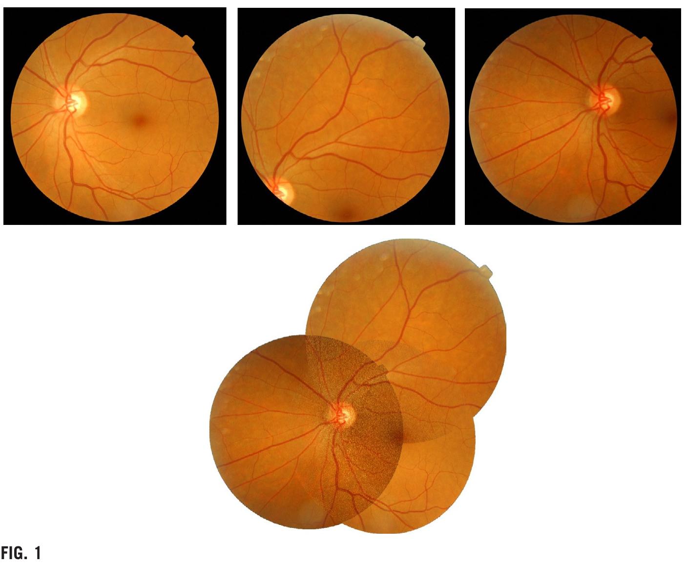 Retinal Image Preprocessing (PDF) Retinal Image Preprocessing, Enhancement and Registration