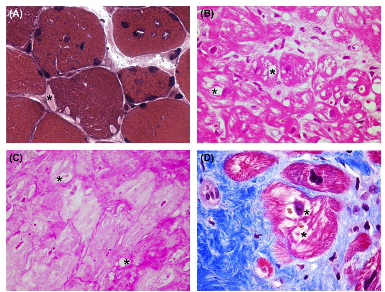 Ultrastructural features of skeletal muscle biopsy from a