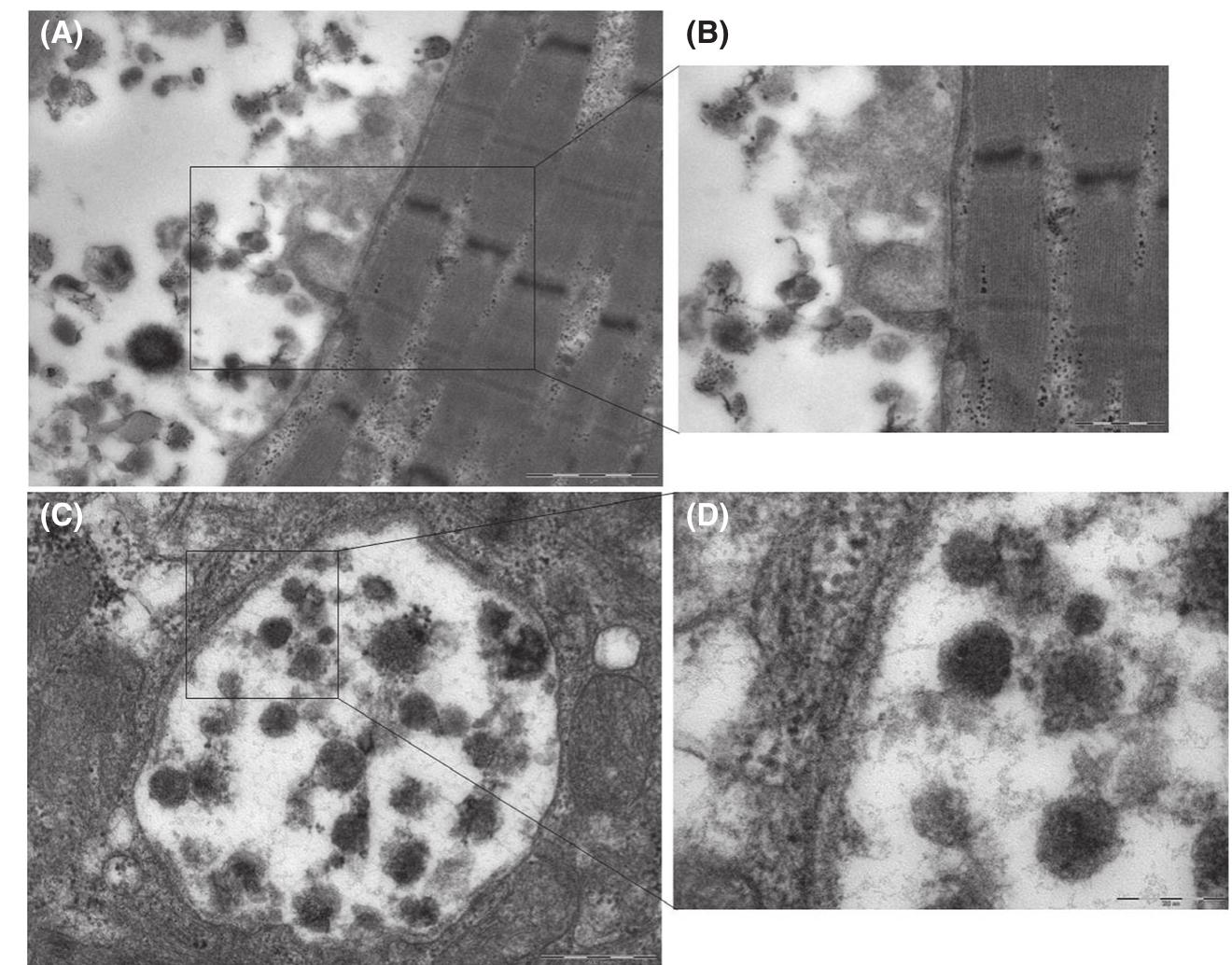 Ultrastructural features of skeletal muscle biopsy from a