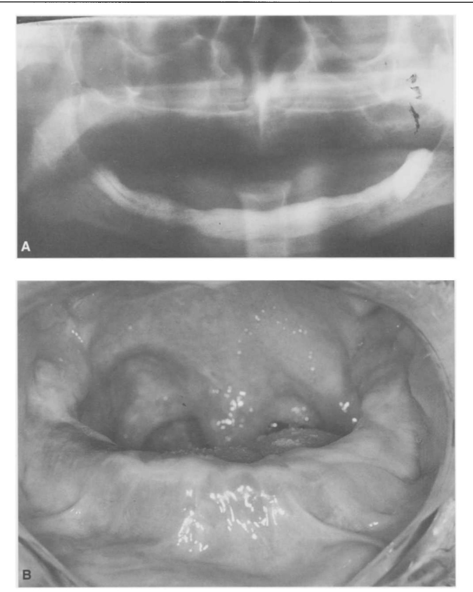 Sufficient Ridges a, panoramic radiograph; b, intraoral photograph
