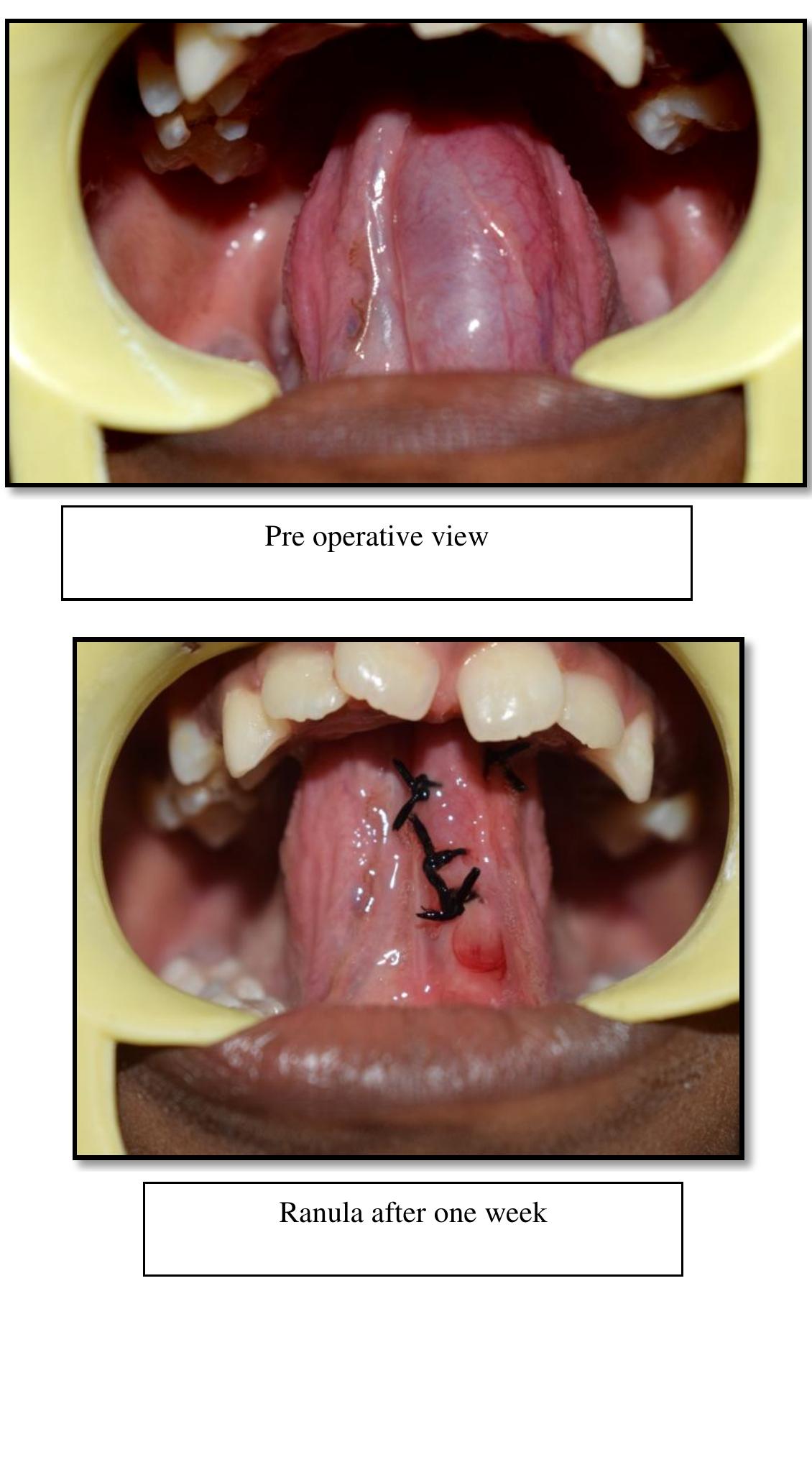 Marsupialization Small Ranula (PDF) Micro-Marsupialization of Sublingual Ranula