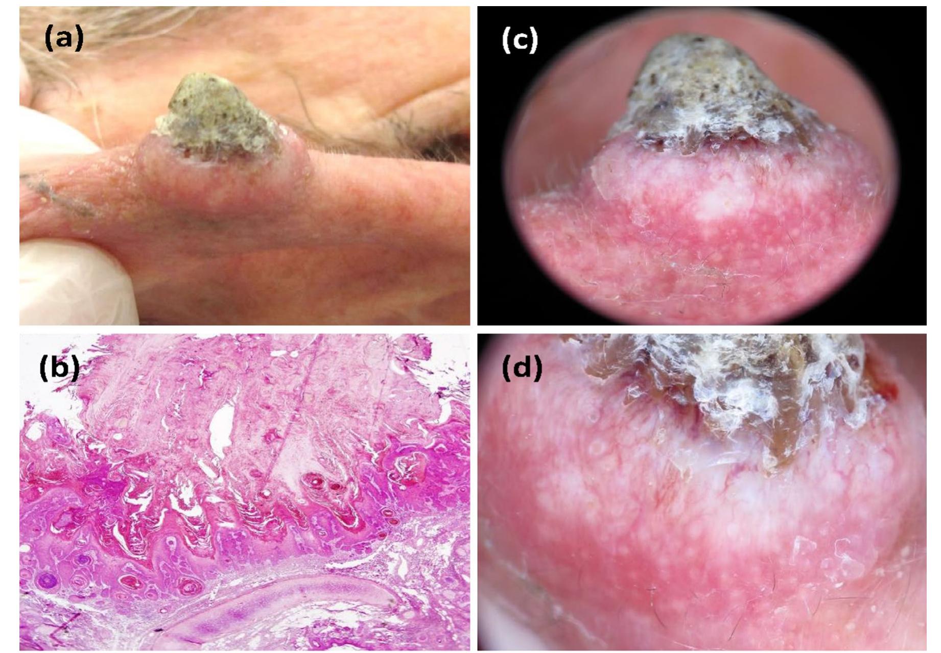 (PDF) Dermoscopy of chondrodermatitis nodularis helicis