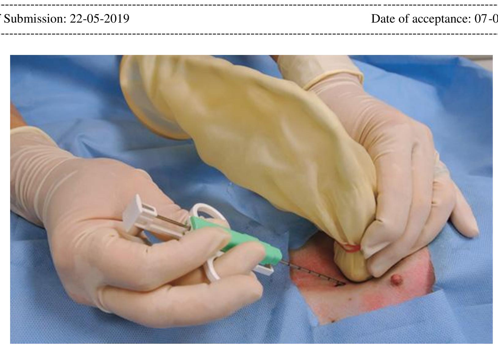 Multiple Abscess Keywords: amoebic liver abscess; percuteneous aspiration;