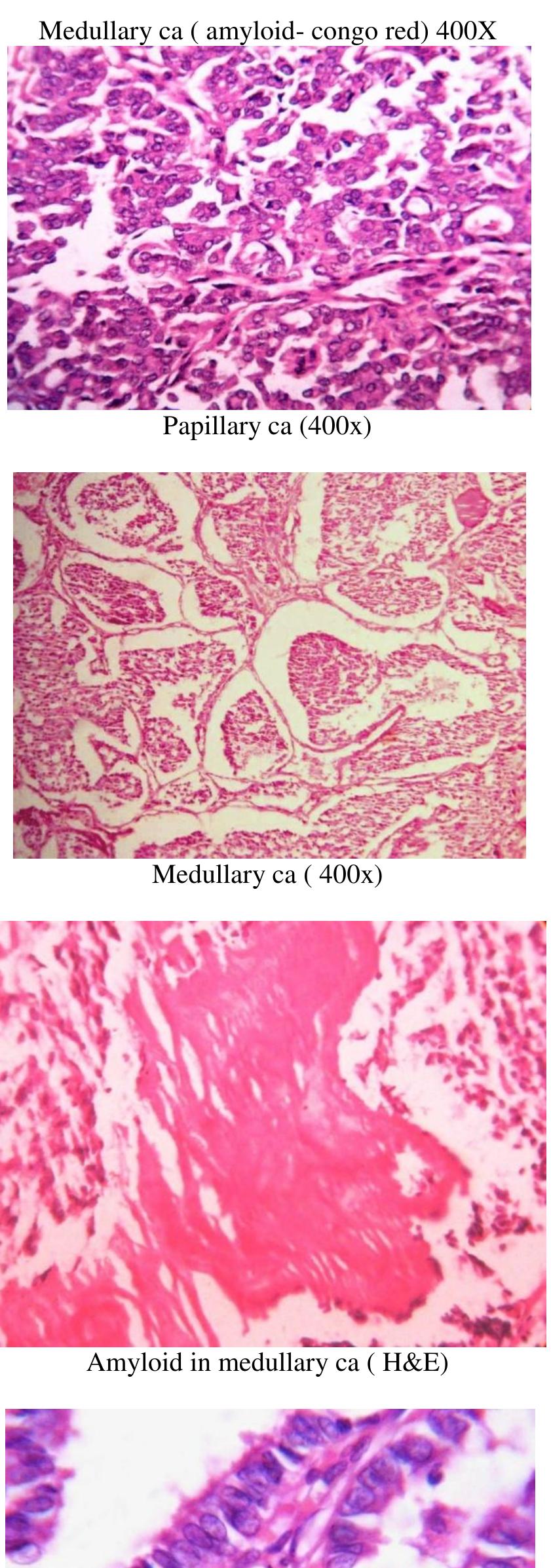 Figure 2 - from Histopathological Spectrum of Thyroid