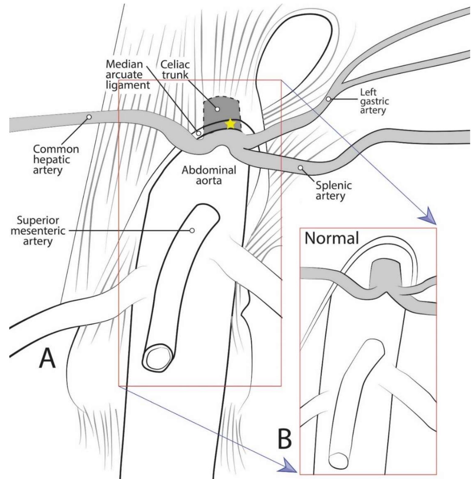 Figure 1. Diagrammatic representation of celiac trunk anatomy, showing: (A) The median arcuate ligament compressing the celiac trunk as in median arcuate ligament syndrome; and (B) normal anatomical condition.  vertebrae [9]. The crura are united in the midline by a tendinous band of fascia, the MAL. The aortic hiatus, an opening between the diaphragm and vertebral column around T12, permits passage of the abdominal aorta through the diaphragm [9]. Simultaneous to the development of the diaphragm, the CT, superior mesenteric artery (SMA), and inferior mesenteric artery (IMA) each form when the respective pair of developing segmental arteries converges at the midline of the abdominal aorta [8]. The CT develops to provide arterial supply to the foregut, the SMA to the midgut, and IMA to the hindgut. As the gut tube develops, the origins of these three unpaired visceral branches migrate caudally until they reach their final vertebral level around the end of month two [8]. The most common vertebral positions reported in adults are: T12 for the CT, L1 for SMA, and L3 for IMA [9]. Thus, the aortic hiatus, bounded by the MAL, frequently approximates the vertebral level of the CT, leaving little space between them. In some cases, the MAL may even overlap the CT, a condition which may result  =  in impingement of the CT.  