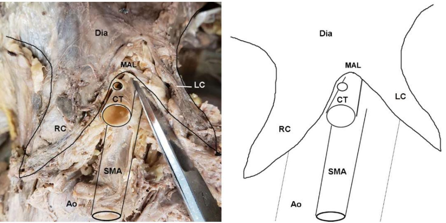 Figure 2. Dissection photo showing compression of the celiac trunk by the median arcuate ligament in a cadaveric subject: (left) Photo; (right) illustration. Abbreviations are as follows: Ao = aorta; CT = celiac trunk; Dia = diaphragm; LC = left crus of diaphragm; MAL = median arcuate ligament; RC = right crus of diaphragm; SMA = superior mesenteric artery.  Figure 2. Dissection photo showing compression of the celiac trunk by the median arcuate ligament  Approximately one-third of subjects (31.4%) were found to exhibit a morphology in which the diaphragm extended further inferiorly than the base of the CT, at least partially covering it (Figure 2; Table S1). Chi-squared tests revealed a highly significant difference in MAL/CT overlap between the sexes (Table 1; X2 = 12.39; p < 0.001), with females exhibiting a significantly higher frequency of MAL/CT overlap than males (44.4% vs. 21.4%). An ANOVA revealed significant differences in the origination angles of both CT (F = 7.256, p = 0.011) and SMA (F = 15.084, p < 0.001) between individuals with MAL/CT overlap and those without. However, there was no significant difference in the vertebral level of the CT or SMA between individuals with MAL/CT overlap versus those without. There was also no significant difference in diameter of CT or in the distance between the CT and SMA. 