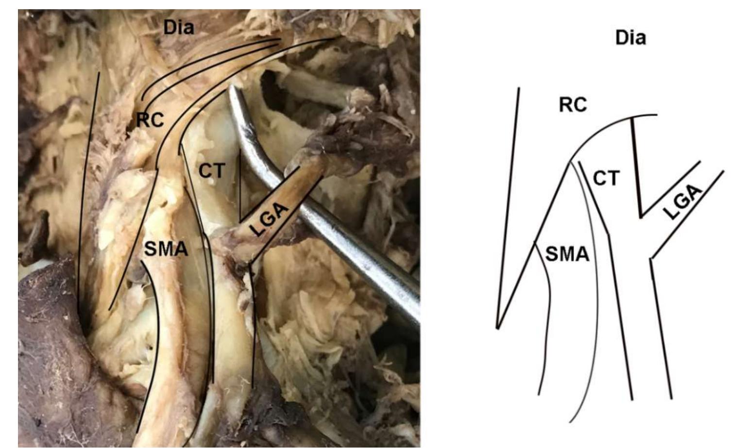 Figure 4. Dissection photo showing overlap of the celiac trunk by the right crus of the diaphragm: (left) Photo; (right) illustration. Abbreviations are as follows: CT = celiac trunk; Dia = diaphragm; LGA = left gastric artery; RC = right crus of diaphragm; SMA = superior mesenteric artery.  Figure 4. Dissection photo showing overlap of the celiac trunk by the right crus of the diaphragm: 