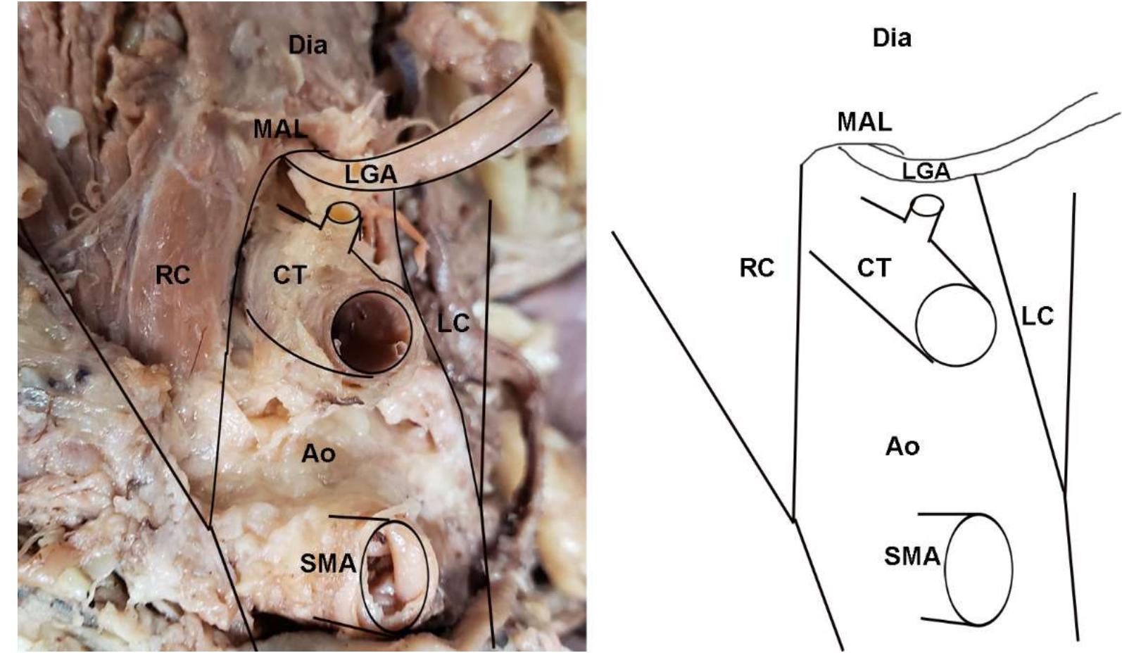Figure 5. A notable variant displaying an uncommon branching of the left gastric artery (LGA) directly off the aorta in a cadaveric specimen: (left) Photo; (right) illustration. This example also demonstrates the direct overlap of the LGA by the median arcuate ligament. Abbreviations are as follows: Ao = aorta; CT = celiac trunk; Dia = diaphragm; LC = left crus of diaphragm; LGA = Left gastric artery; MAL = median arcuate ligament; RC = right crus of diaphragm; SMA = superior mesenteric artery. 