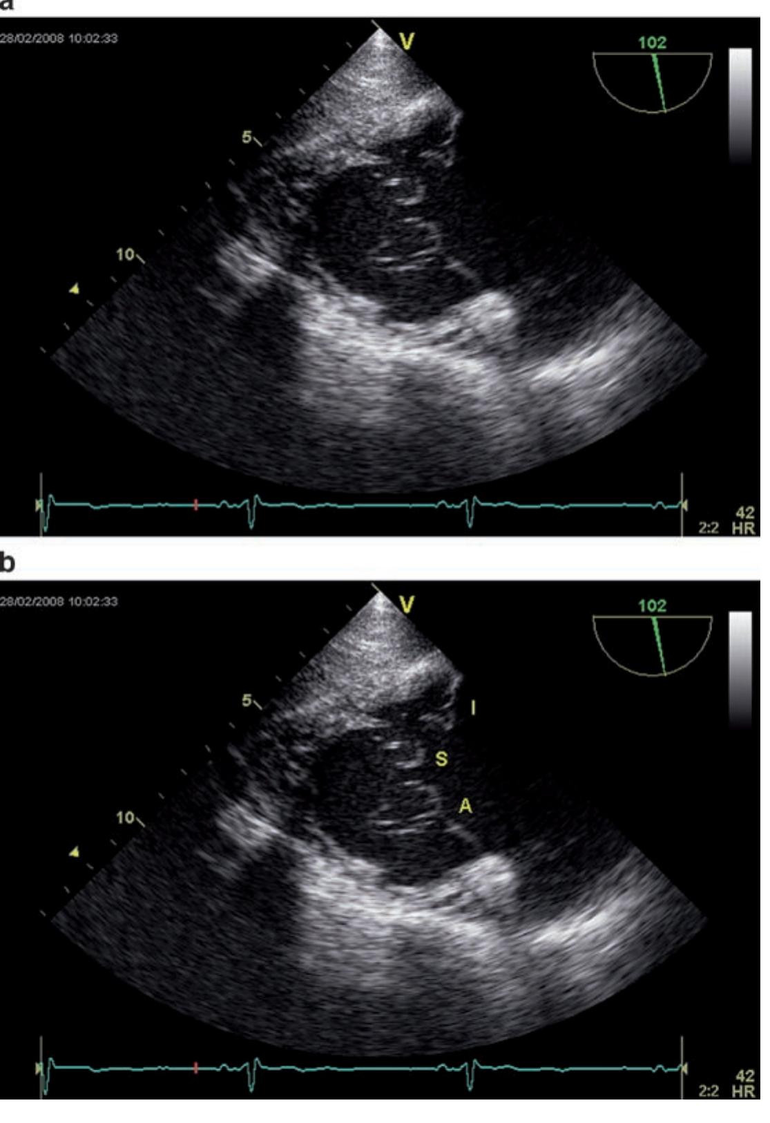 PDF) Transesophageal Echocardiography in Clinical Practice